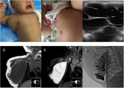 Simulated Angiography Using a Bleomycin Mixture for Sclerotherapy of Lymphatic Malformations